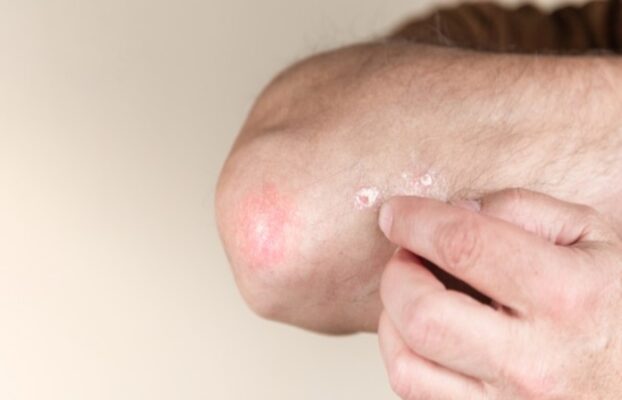 Atopic Dermatitis: Take Care Of Your Skin From It - Health Cares World